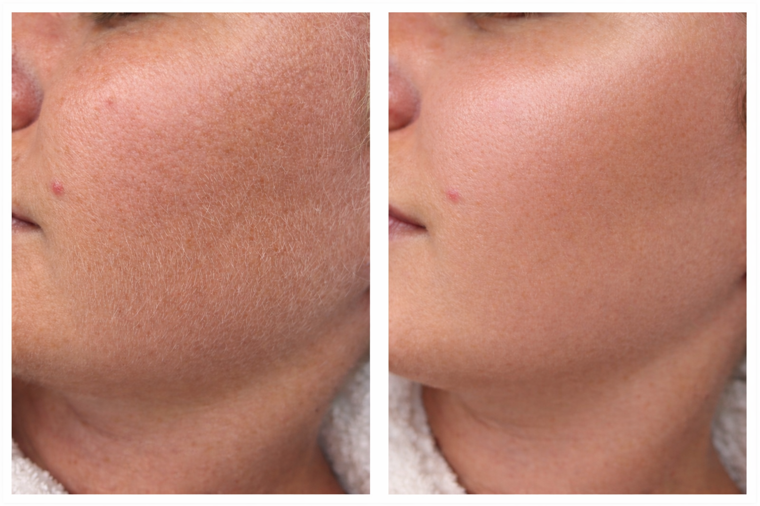 Dermaplaning treatment before and after results