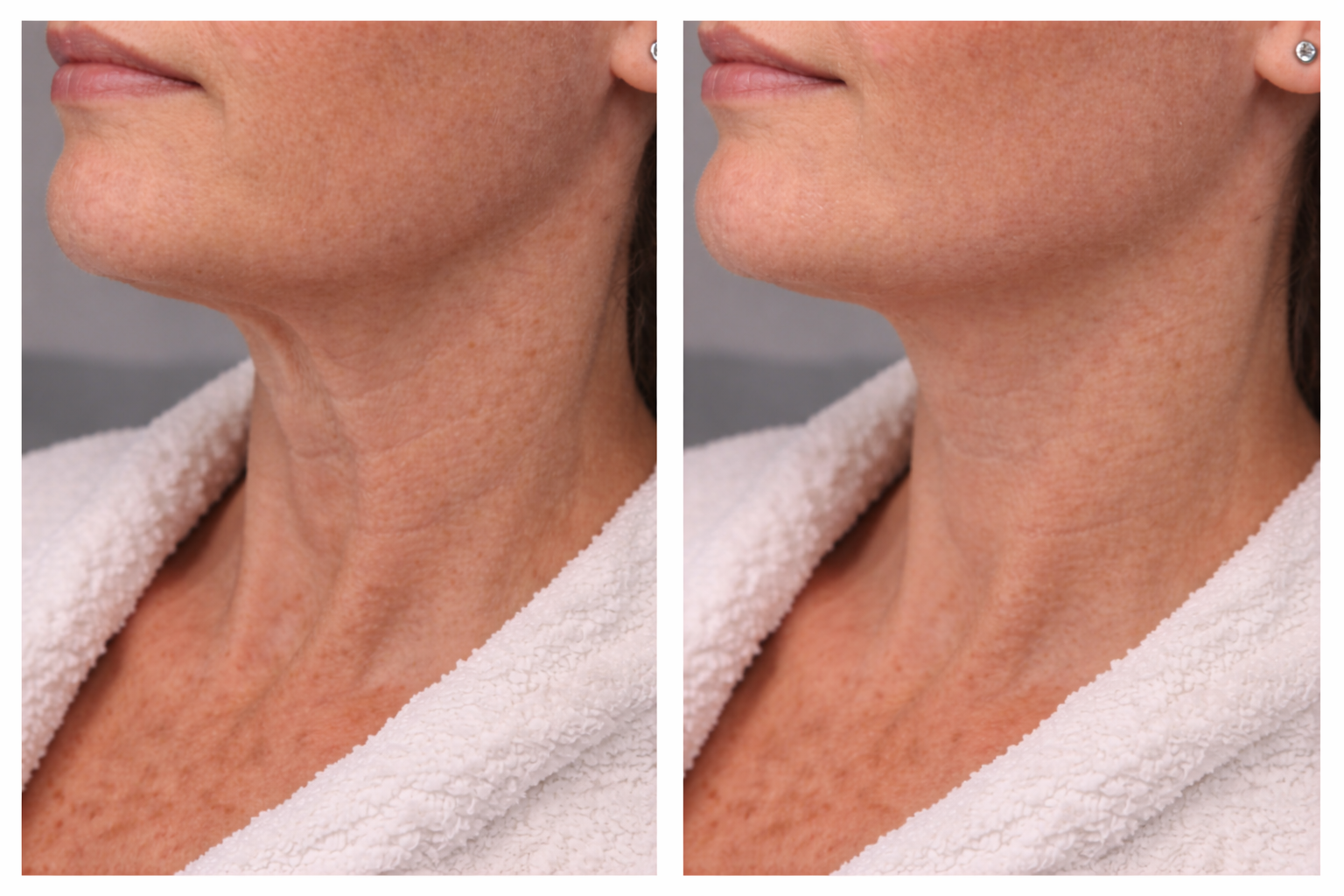 Platysma bands treatment before and after results