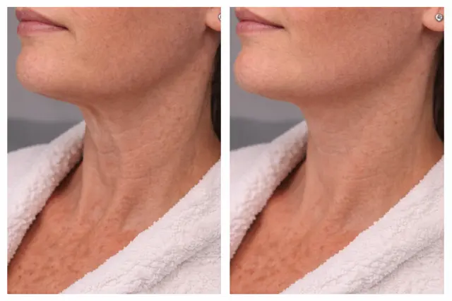 Platysma bands treatment before and after results