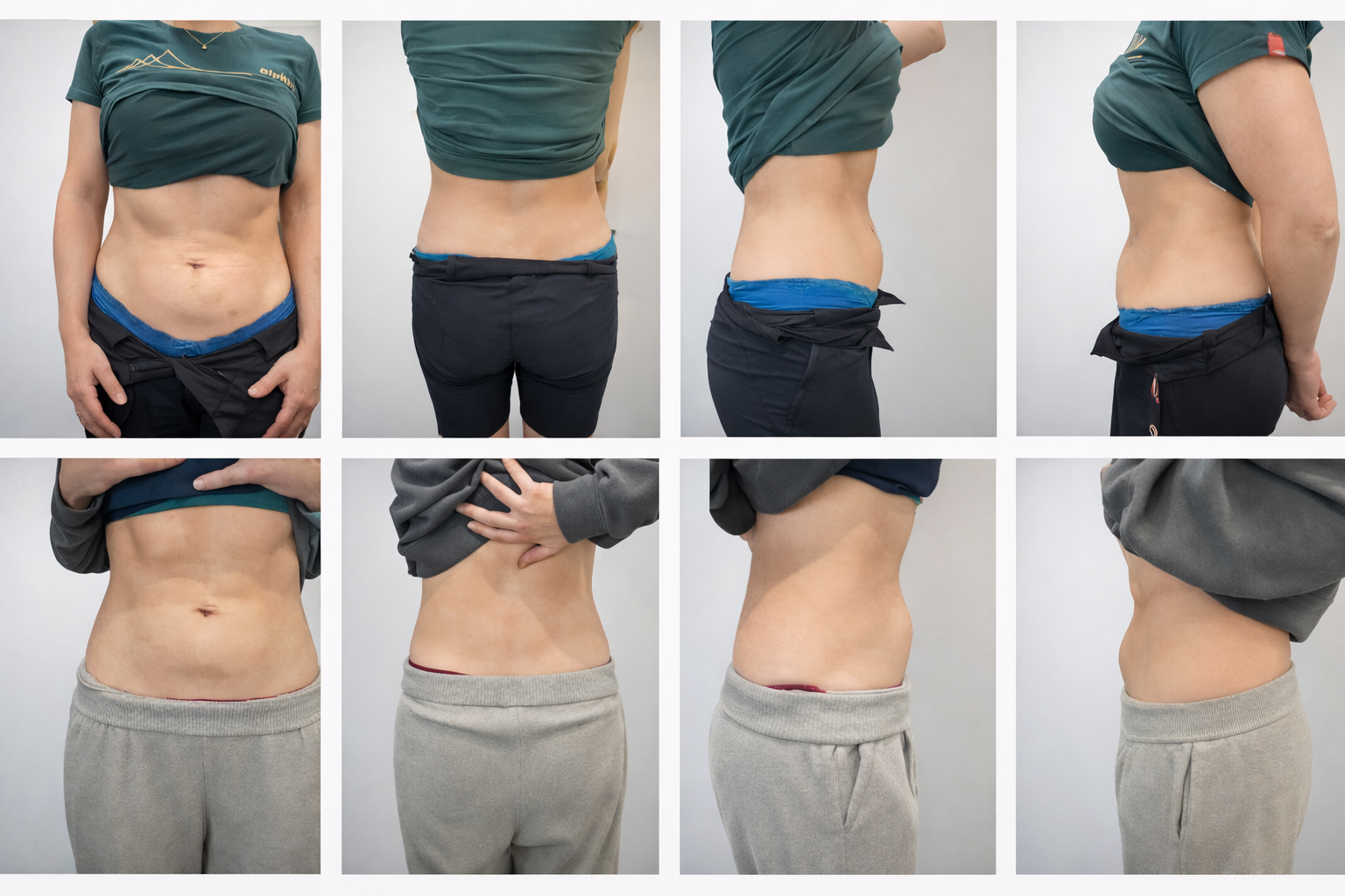 Fat dissolving body contouring treatment