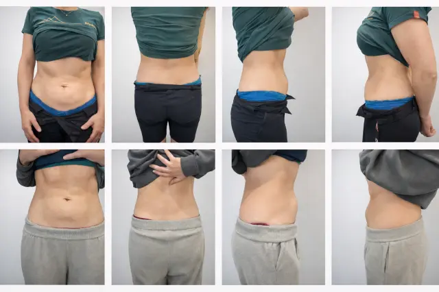 Fat dissolving body contouring treatment