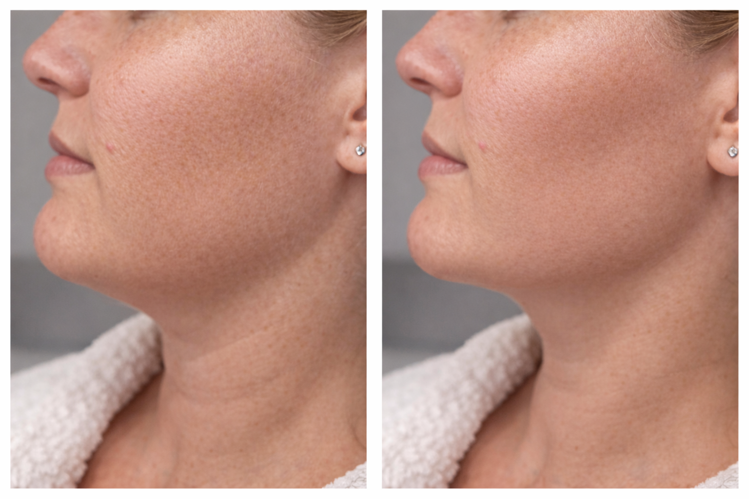 Jawline contouring aesthetic treatment in a clinical setting