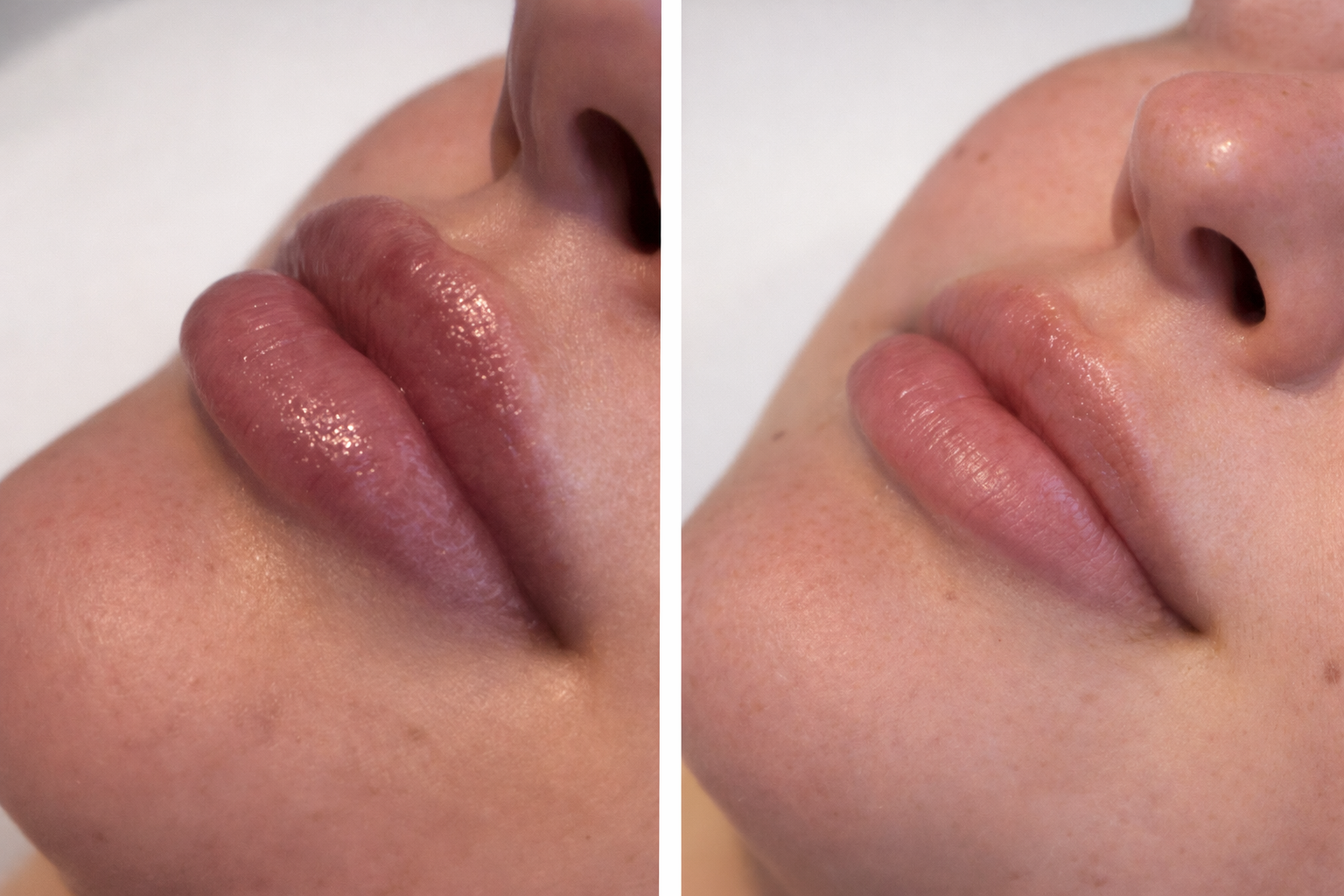 Lip filler treatment before and after results
