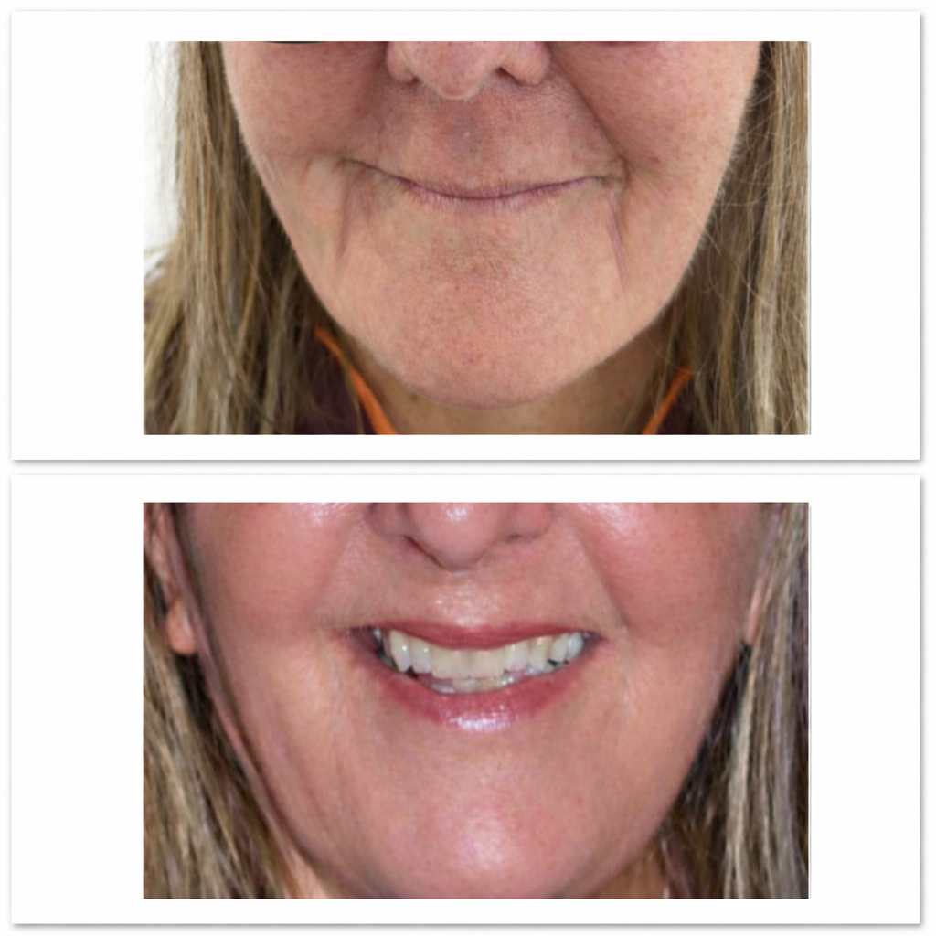 Marionette lines filler before and after results