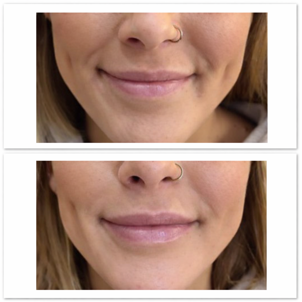 Nasolabial lines filler before and after results