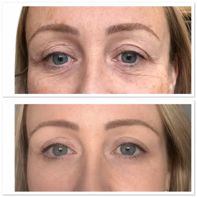 Polynucleotides eye treatment before and after results
