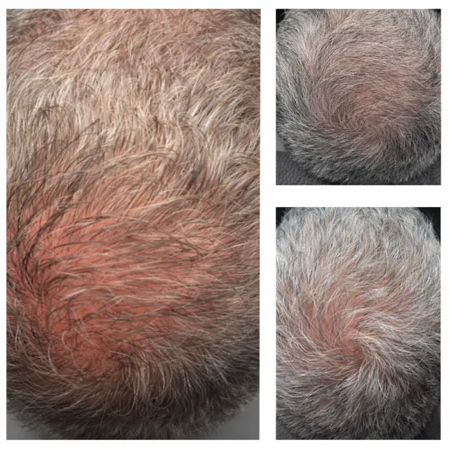 Scalp treatment before and after results